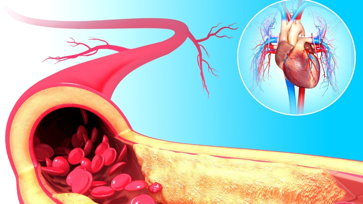 What Is Atherosclerosis?